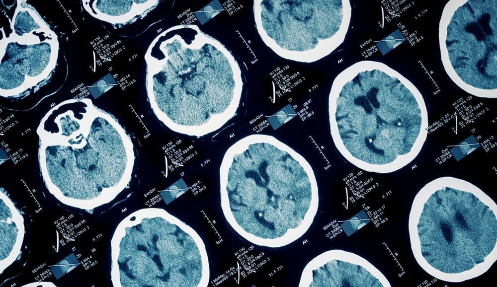 Brain scans